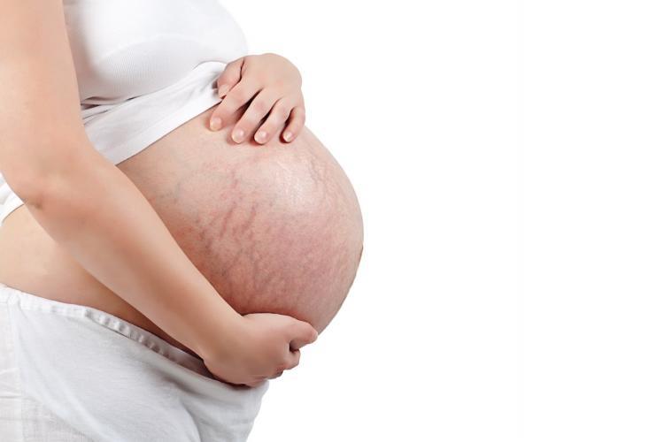 Rozstępy w ciąży - jak szybko pozbyć się blizn