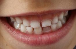 Aż 40% 3-latków ma próchnicę - jak prawidłowo dbać o zęby maluchów