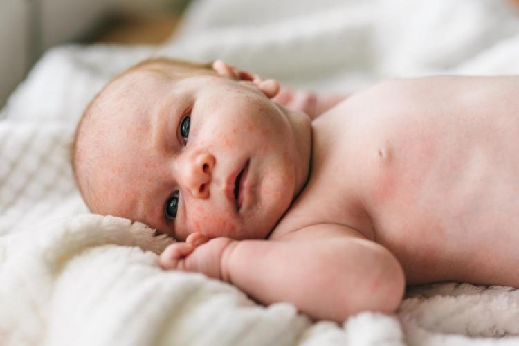 Jak rozpoznać trądzik niemowlęcy?